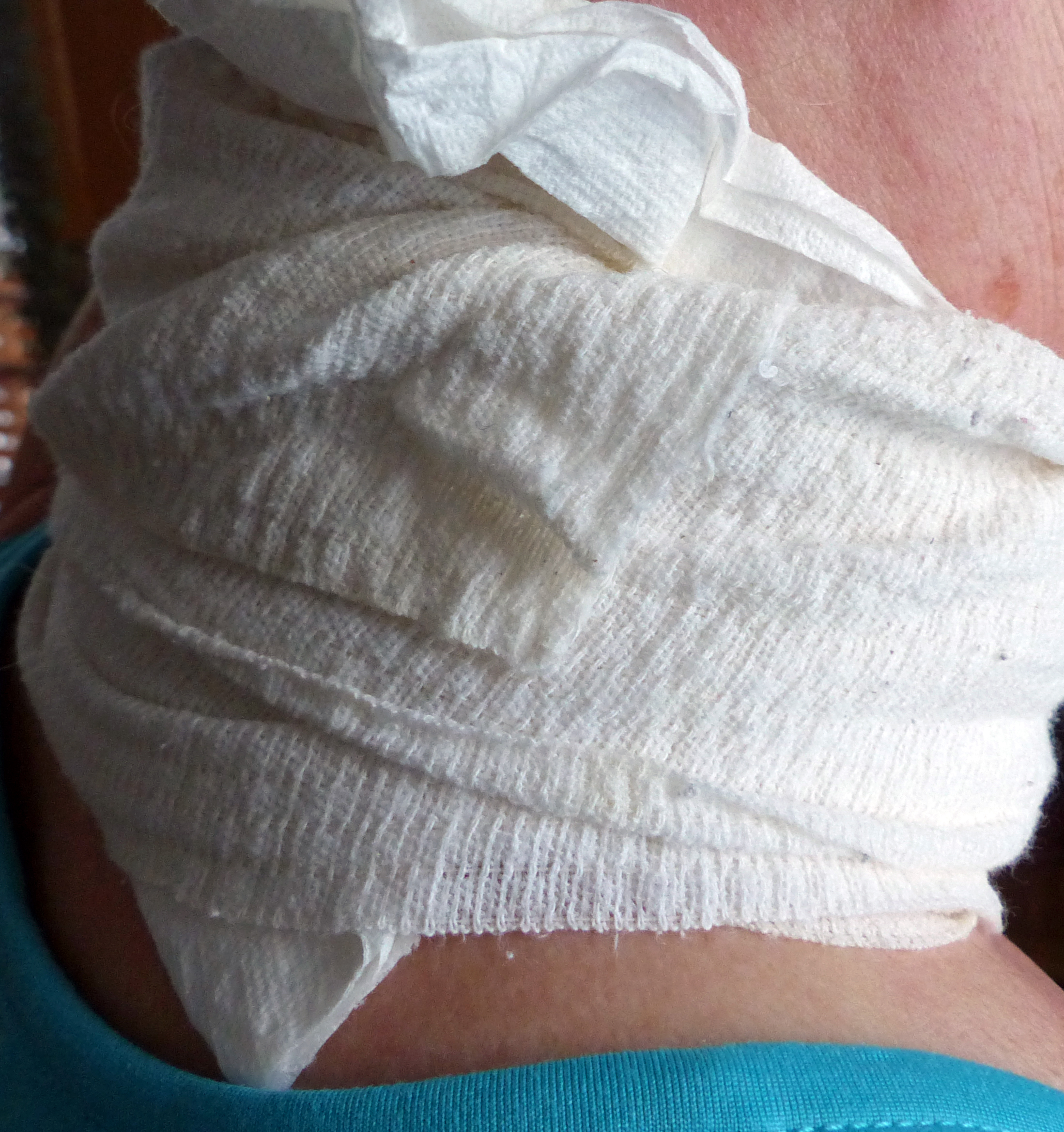 Topfenauflage, Topfenpatscherl als volksmed. Hilfe